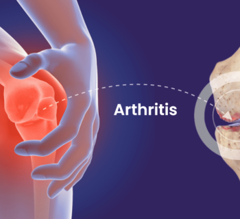 Arthritis0-1024×536 Arthritis0-1024x536